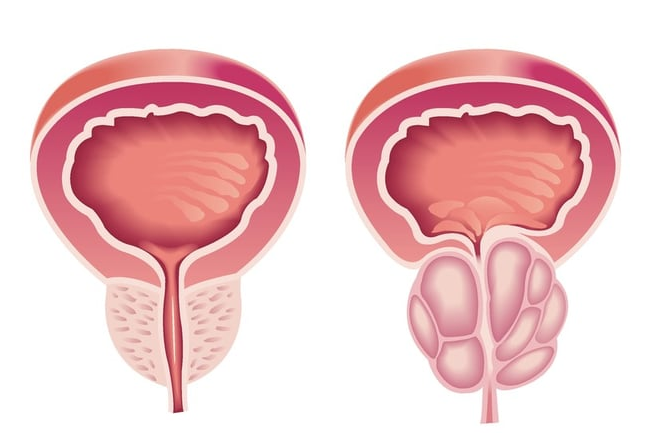 U xơ tiền liệt tuyến và cách cải thiện nhờ Tiền Liệt Tuyến Á Âu