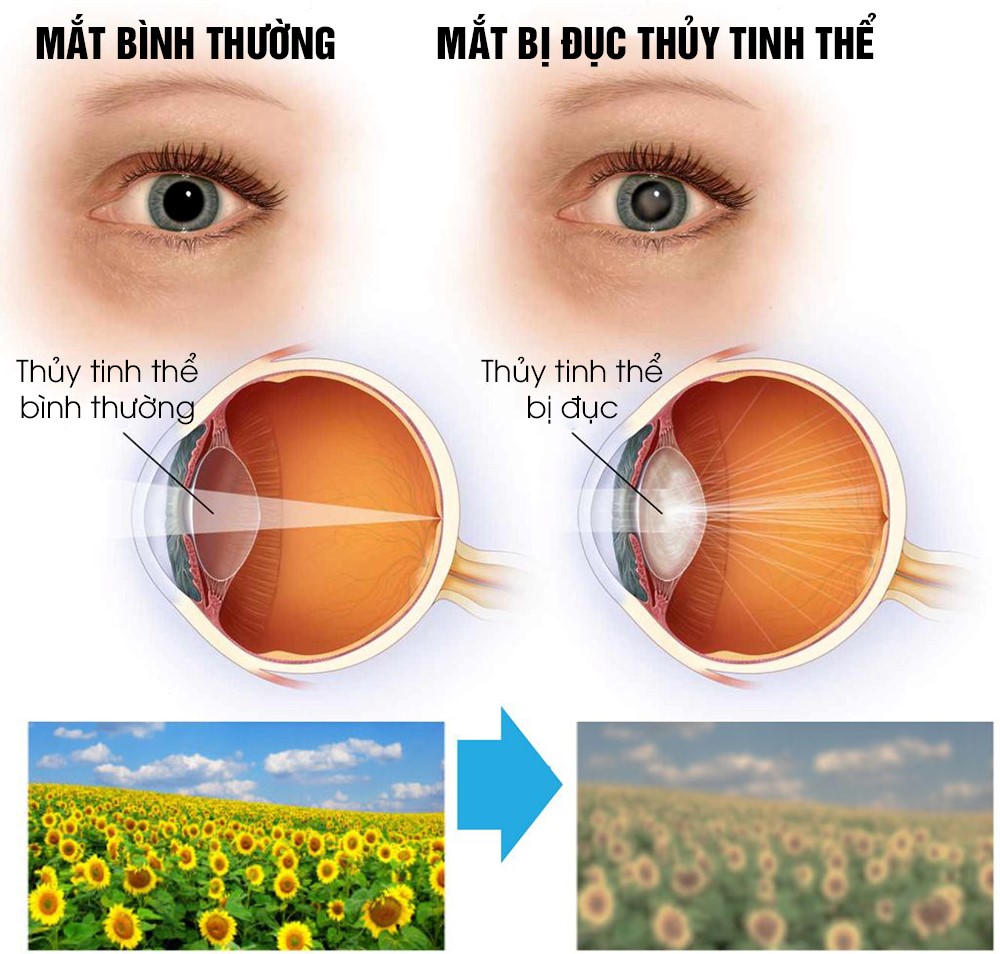 Đục thủy tinh thể (cườm khô) – Cách trị hay không cần mổ 