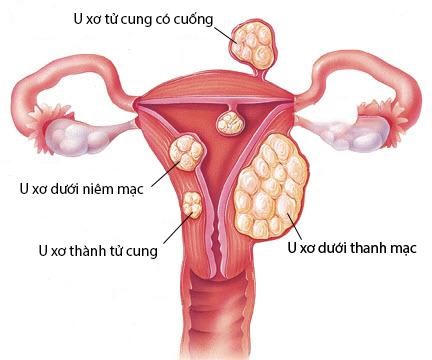 Các dạng u xơ tử cung và giải pháp cải thiện bằng Nga Phụ Khang