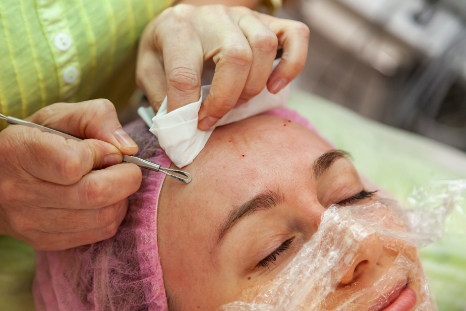 Cách trị mụn trứng cá và giải pháp từ kem thảo dược ngừa mụn Azacné