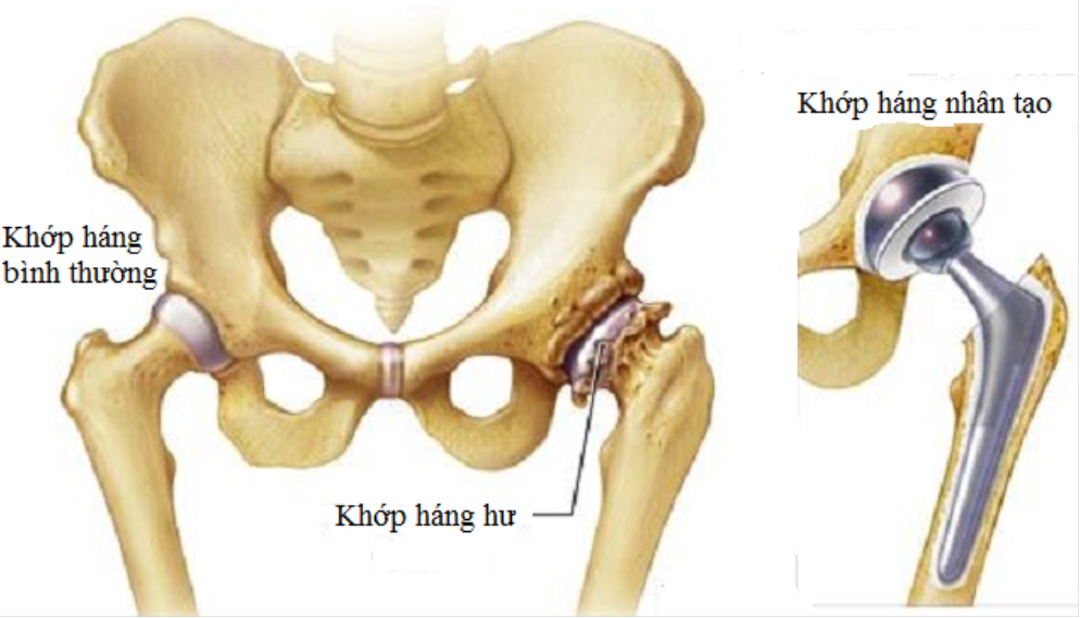 Nhận biết sớm viêm khớp háng để có cách điều trị sớm, tránh phải thay khớp