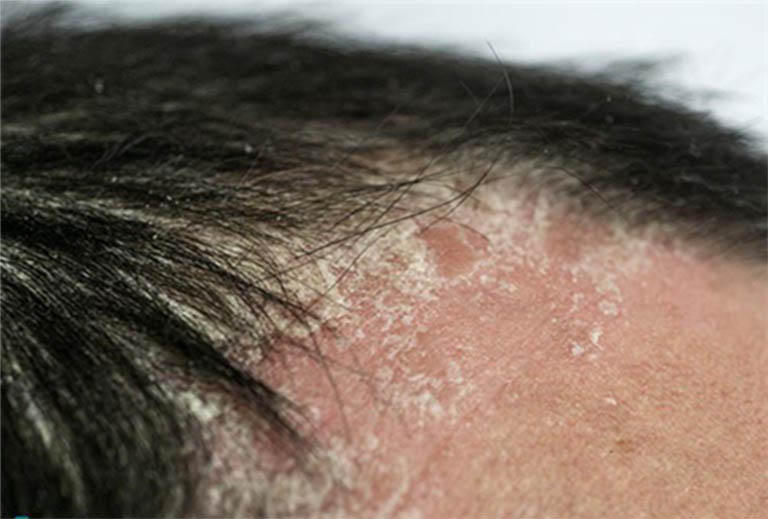 Khổ sở vì á sừng da đầu, hãy dùng ngay kem dược liệu Explaq!