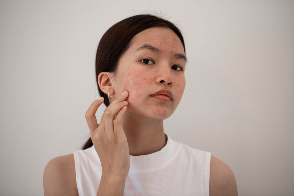 Thuốc trị mụn trứng cá và giải pháp từ kem thảo dược ngừa mụn Azacné