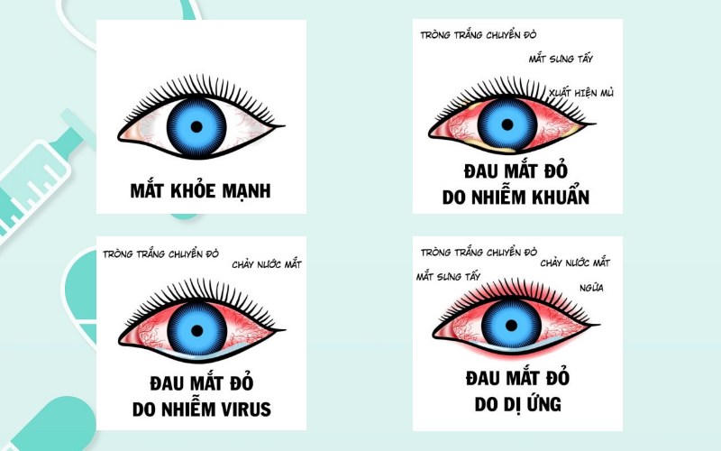 Cách chữa đau mắt đỏ nhanh khỏi tại nhà