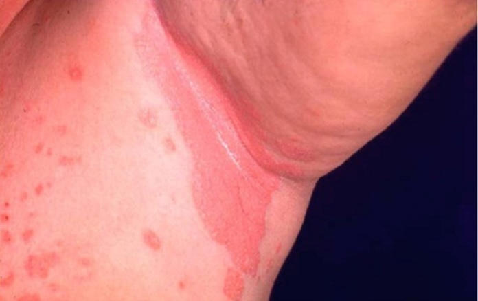 Vảy nến thể đảo ngược và cách cải thiện từ kem bôi Explaq