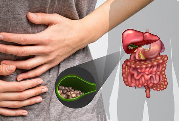 Bệnh sỏi mật - Nguyên nhân, biến chứng và cách bài sỏi với Kim Đởm Khang