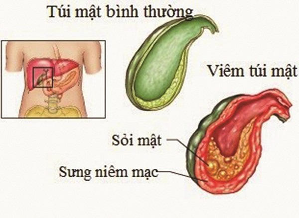 Bệnh sỏi mật - Nguyên nhân, biến chứng và cách bài sỏi với Kim Đởm Khang