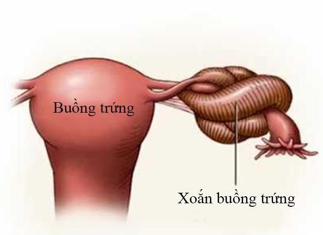 Các biến chứng nguy hiểm của u nang buồng trứng và cách phòng ngừa từ Nga Phụ Khang