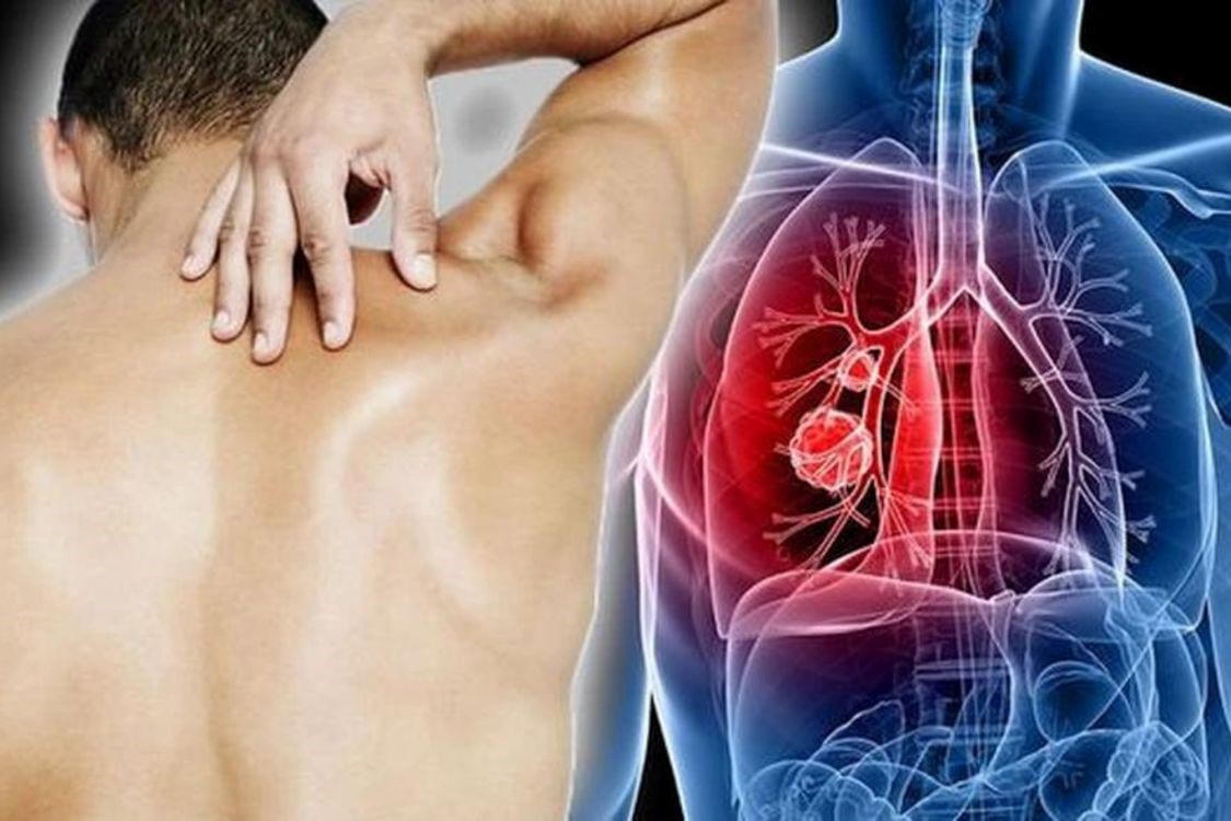 Nguyên nhân ung thư phổi và cách hỗ trợ phòng ngừa hiệu quả nhờ Tumolung