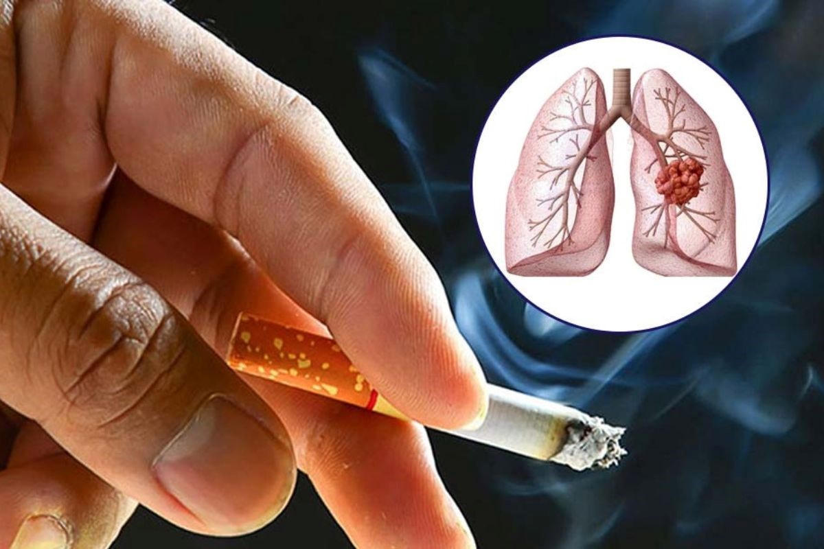 Nguyên nhân ung thư phổi và cách hỗ trợ phòng ngừa hiệu quả nhờ Tumolung