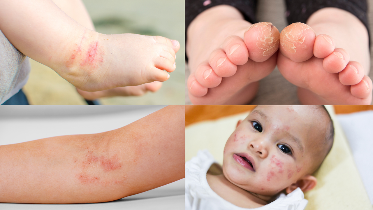 Chàm sữa ở trẻ và cách cải thiện nhanh với Eczestop