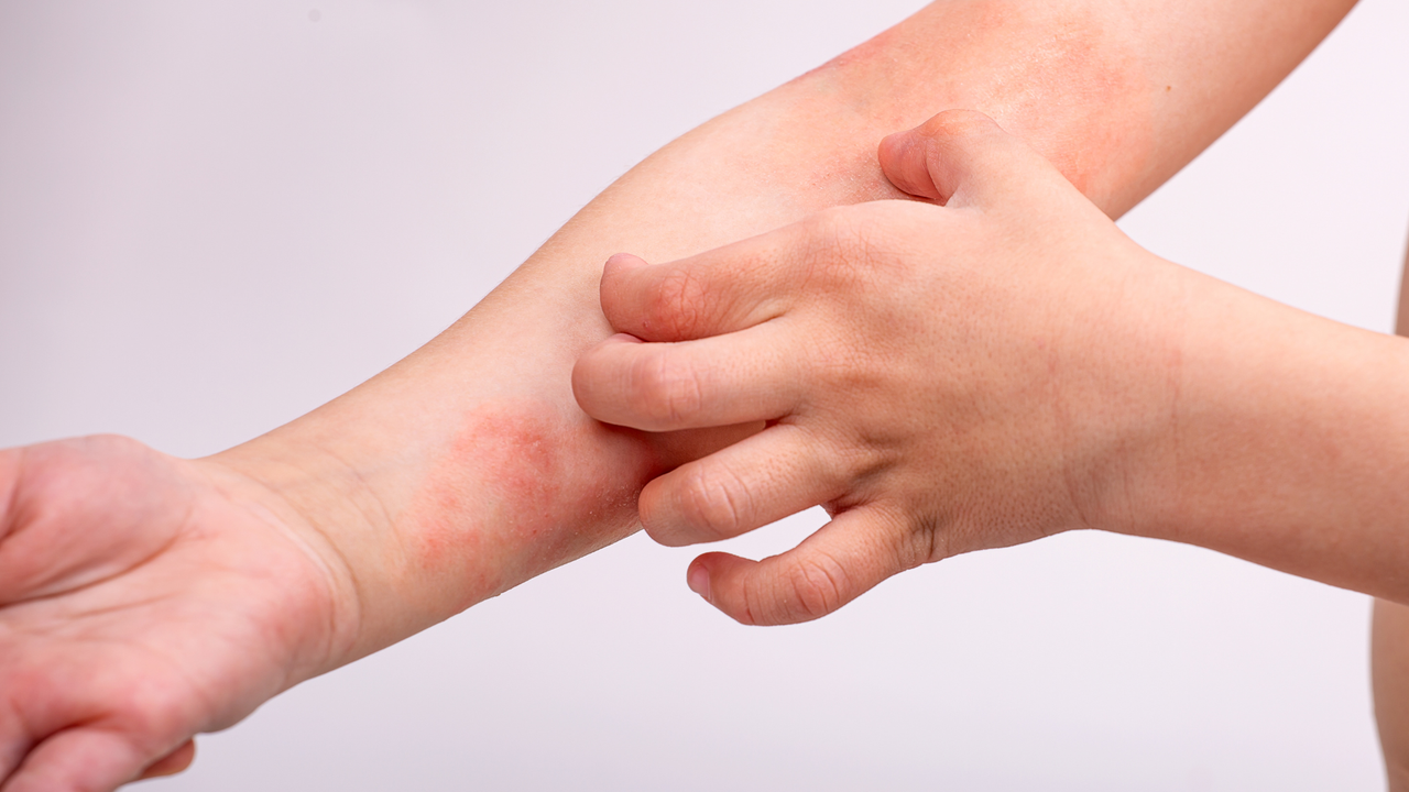 Chàm sữa ở trẻ và cách cải thiện nhanh với Eczestop