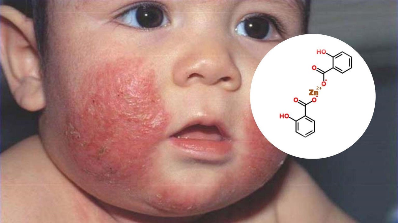 Chàm sữa ở trẻ và cách cải thiện nhanh với Eczestop