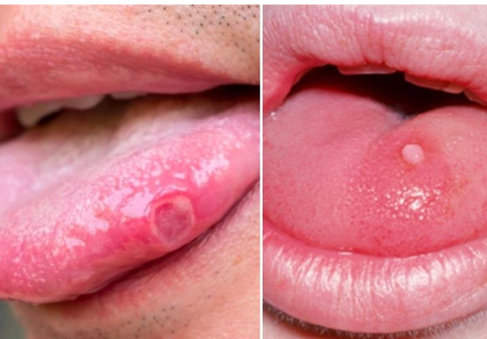 5 lý do nên lựa chọn gel Gumimouth khi bị viêm loét miệng, nhiệt miệng, nhiệt lưỡi