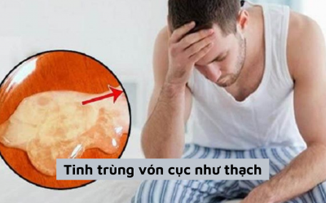 Tinh trùng vón cục: Nguyên nhân và giải pháp cải thiện từ Linh Tự Đan