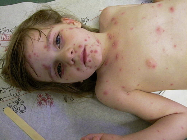 Bệnh thủy đậu nguy hiểm ra sao và giải pháp từ bộ đôi Subạc
