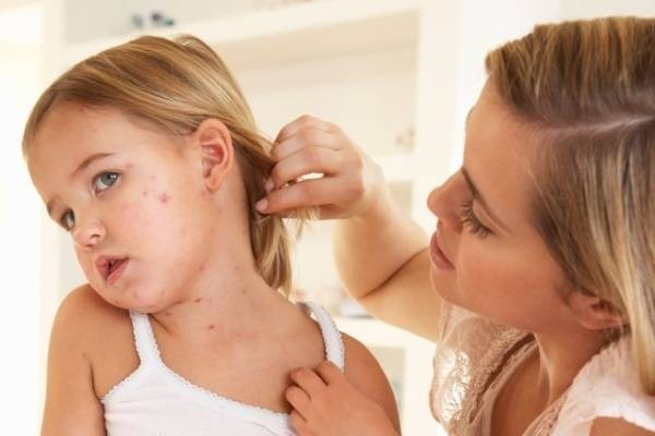 Bệnh thủy đậu nguy hiểm ra sao và giải pháp từ bộ đôi Subạc