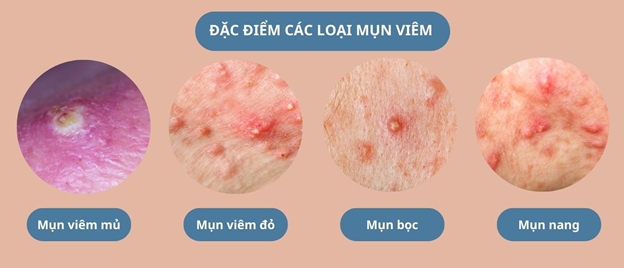 Cách giảm mụn viêm an toàn, hiệu quả với kem bôi thảo dược Azacné