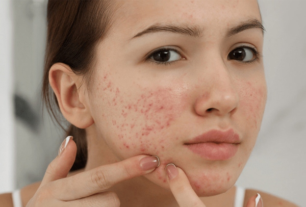 Cách giảm mụn viêm an toàn, hiệu quả với kem bôi thảo dược Azacné