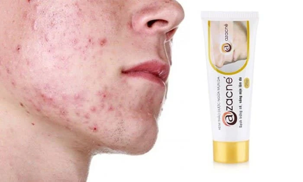 Cách giảm mụn viêm an toàn, hiệu quả với kem bôi thảo dược Azacné