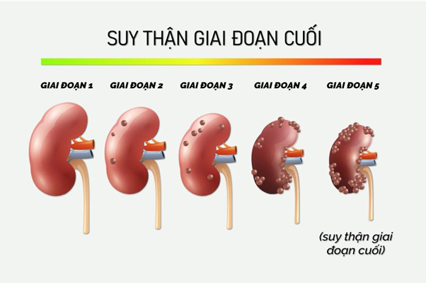 Suy thận giai đoạn 5 - Mức độ nguy hiểm và cách cải thiện từ Ích Thận Vương