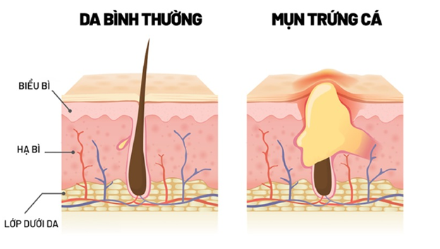 Bí quyết giảm mụn trứng cá nặng từ kem thảo dược Azacné