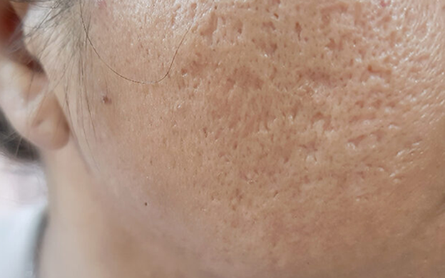 Bí quyết giảm mụn trứng cá nặng từ kem thảo dược Azacné