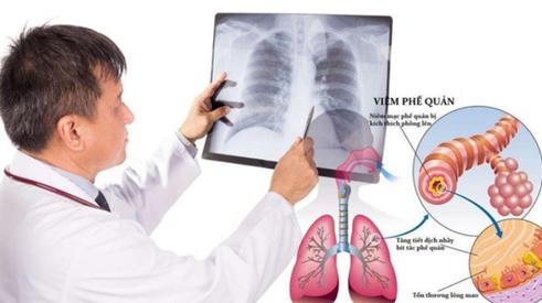 Viêm phế quản cấp: Nguyên nhân, dấu hiệu và cách phòng ngừa hiệu quả