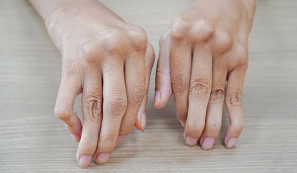 Biến chứng nguy hiểm của viêm khớp dạng thấp và giải pháp hỗ trợ phòng ngừa từ Hoàng Thấp Linh