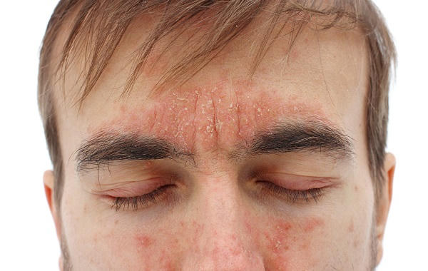 Triệu chứng nhận biết viêm da cơ địa và giải pháp cải thiện nhờ kem làm sạch da Eczestop