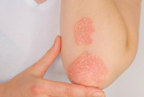 Tìm hiểu về bệnh vảy nến thể mảng và giải pháp cải thiện từ Kim Miễn Khang