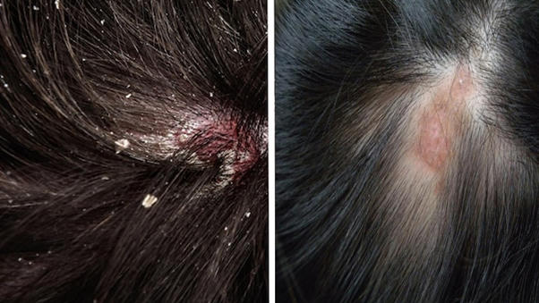 Gàu, nấm da đầu: Cảnh báo nguy cơ gây rụng tóc và cách cải thiện hiệu quả