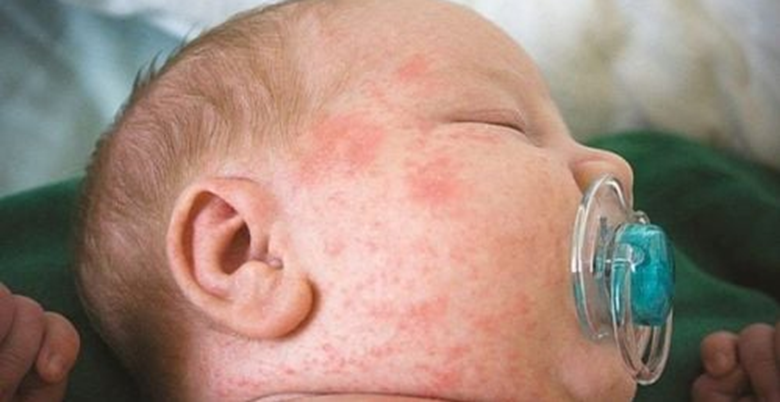 Những biến chứng của bệnh sởi và giải pháp nhờ bộ sản phẩm Subạc