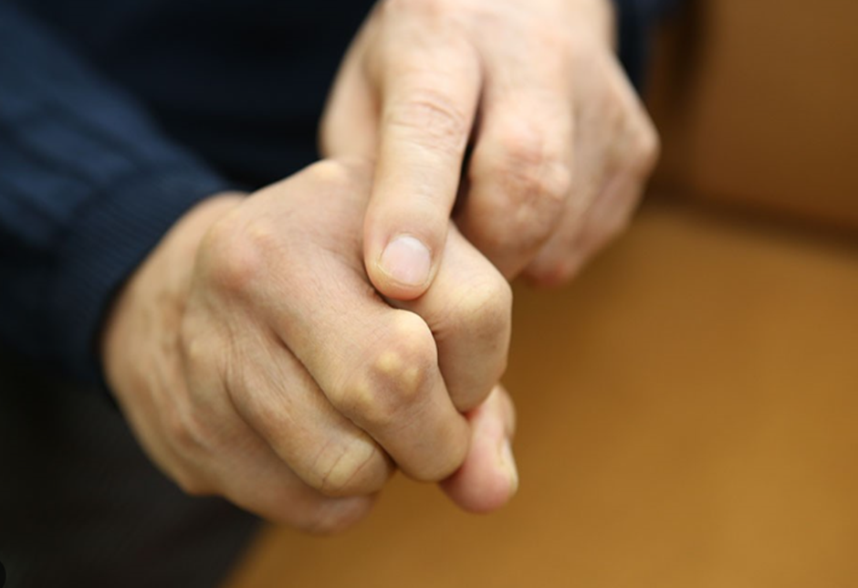 Biến chứng nổi tophi ở người bệnh gút và cách phòng ngừa nhờ Hoàng Thống Phong