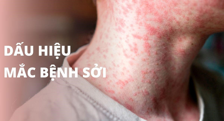 Bệnh sởi ở người lớn có nguy hiểm không và giải pháp từ bộ sản phẩm Subạc