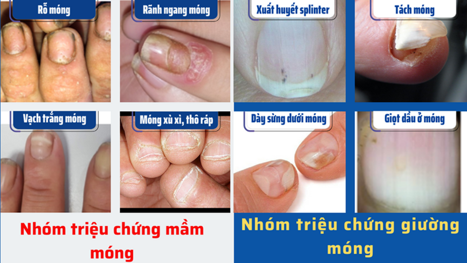 Vảy nến móng tay và cách cải thiện nhờ kem bôi Explaq