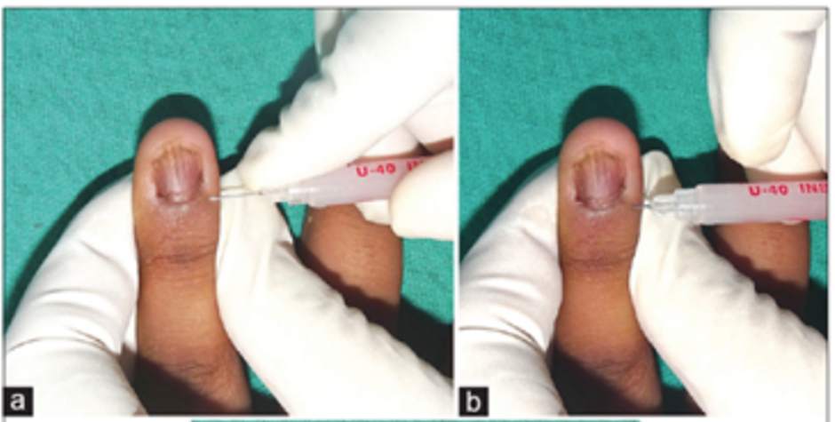 Vảy nến móng tay và cách cải thiện nhờ kem bôi Explaq