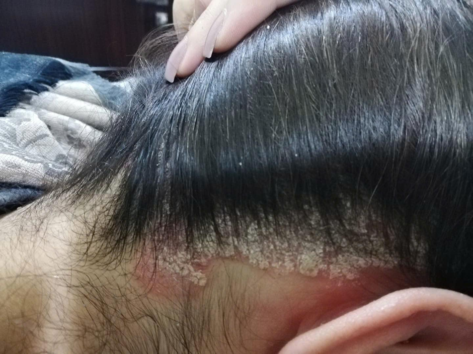 Da đầu bị gàu, ngứa dai dẳng: Nguyên nhân và cách chọn dầu gội tốt nhất