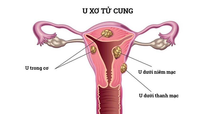 Bị u xơ tử cung có nên mổ không và giải pháp hỗ trợ cải thiện nhờ thảo dược