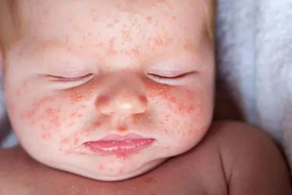 Cách cải thiện rôm sảy vào mùa hè cho bé