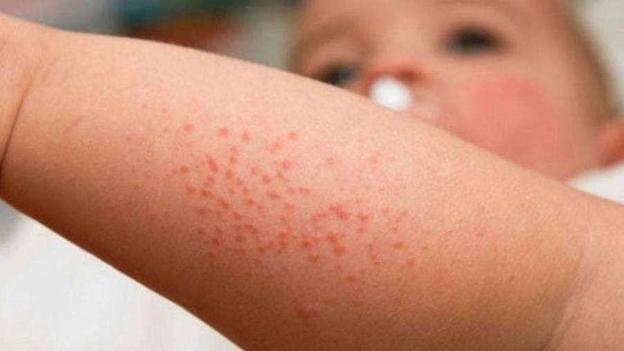 Cách cải thiện rôm sảy vào mùa hè cho bé