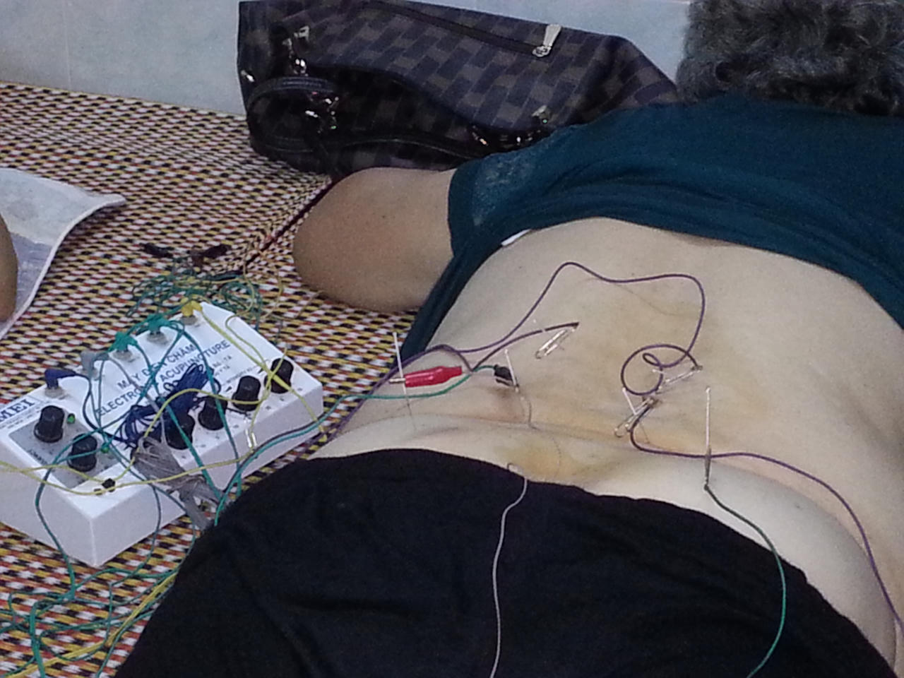 Phương pháp điều trị đau thần kinh tọa đơn giản mà hiệu quả