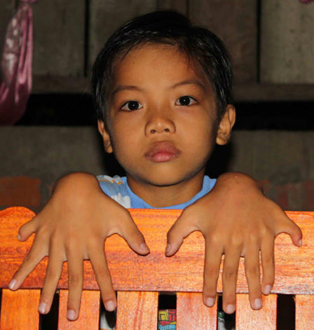 “Giải mã” gia tộc 6 đời dư ngón chân tay