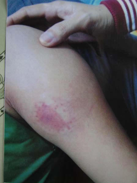 Anh rể cắn “nhũ hoa” em vợ: khó định tội danh?