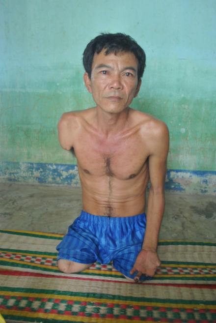 Người đàn ông mắc bệnh lạ, 15 năm 23 lần cắt bỏ tay, chân