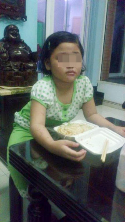 “Đốt” con  gái 6 tuổi để “dạy dỗ”