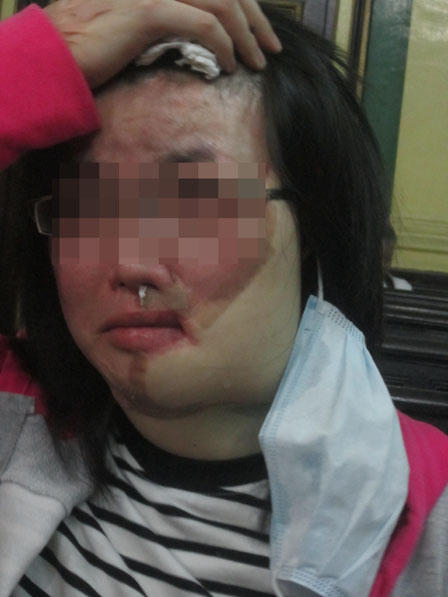 Cô dâu xinh đẹp bị tạt axit ngay trước ngày cưới