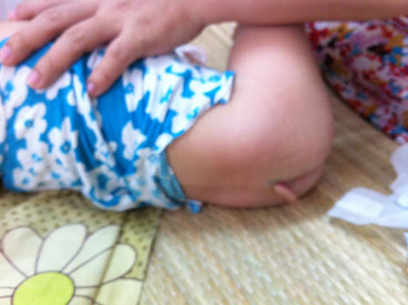 Bé gái “mọc đuôi”, cả nhà khốn đốn