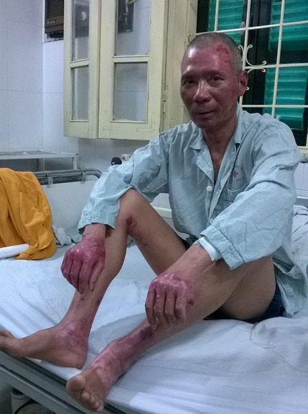 Giây phút kinh hoàng của người đàn ông ôm “bom gas” cứu vợ và đám trẻ