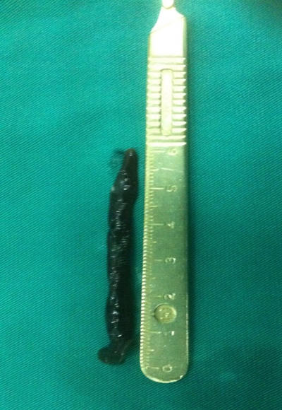 Con đỉa trâu sống nhiều ngày trong mũi bé trai 2 tuổi